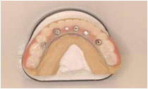 手術直後に入れる仮の歯