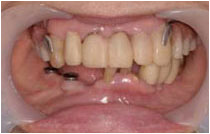 他院での仮歯の状態